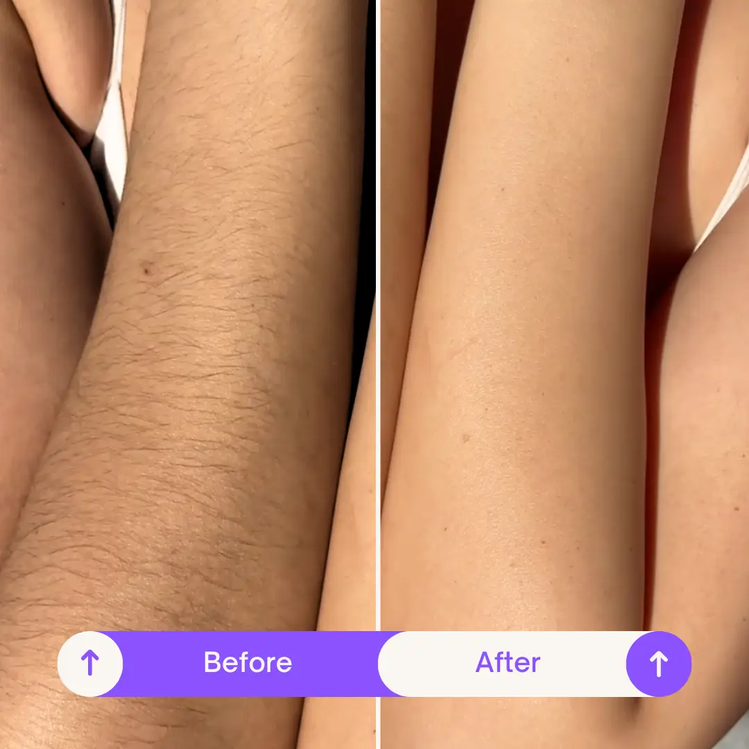Arms before and after BodySense