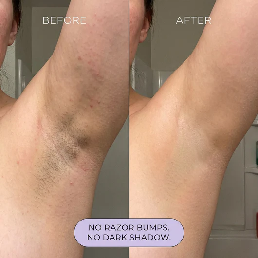 Underarms before and after BodySense